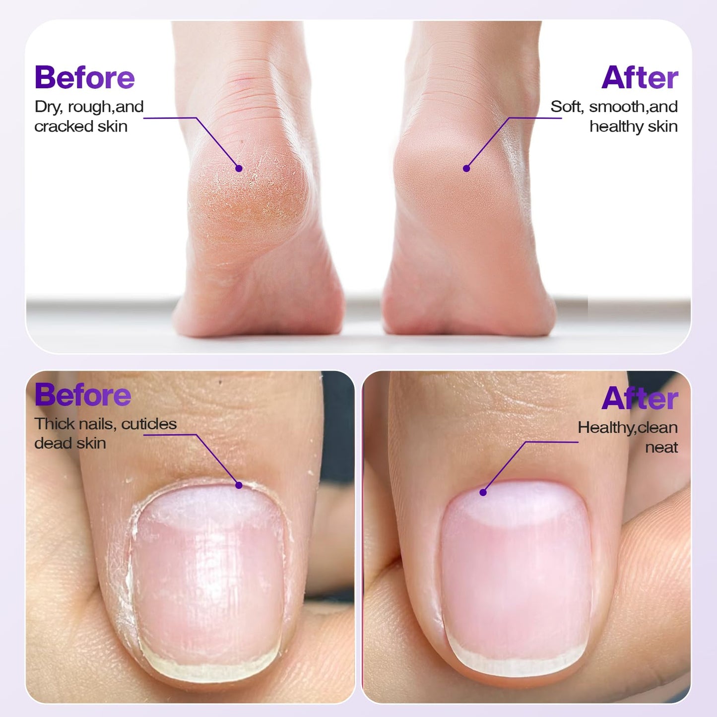 Professional Electric Nail Drill 2000mAH Portable Cordless Electric Nail File 10 in 1 Manicure Pedicure Kit ,5-Speeds Toe Nail Tools Hand Foot Care,Thick Toenail Grinder for Women Men Pets (Purple)